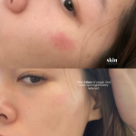 rednesscream before and after (1)