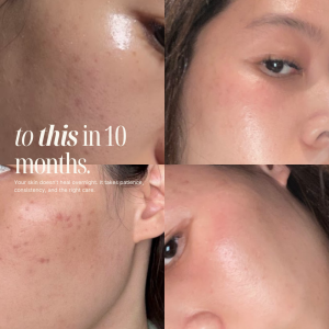 MySkin2